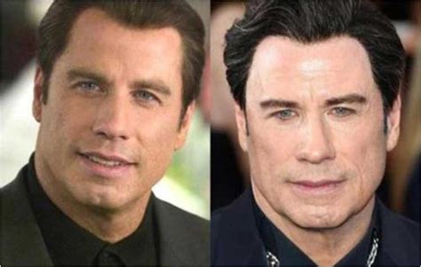 john travolta face lift|John Travolta’s Botox and Facelift